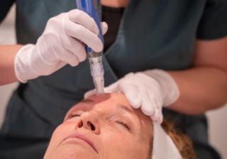 SkinPen Microneedling