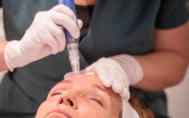 Huidverbetering op het hoogste niveau met SkinPen microneedling