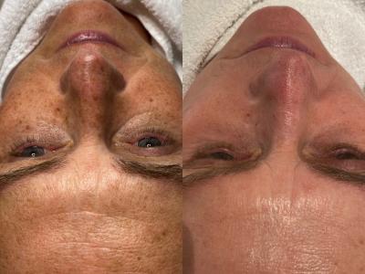Anti Aging behandeling