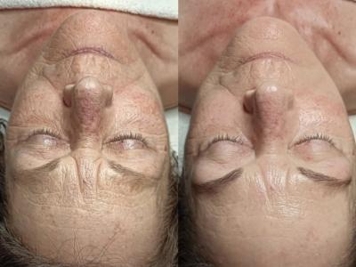 Anti Aging behandeling
