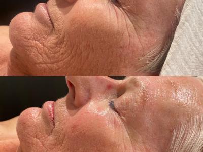 Anti Aging behandeling