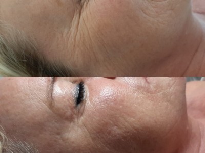 Anti Aging behandeling