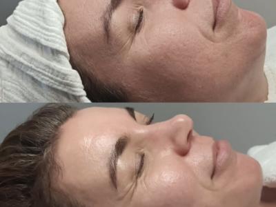 Brighten&Renew Treatment Series