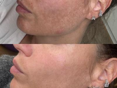 Brighten&Renew Treatment Series