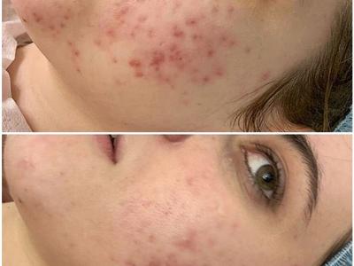 Chemische peeling