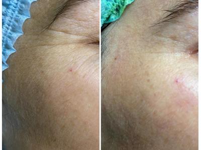 Chemische peeling
