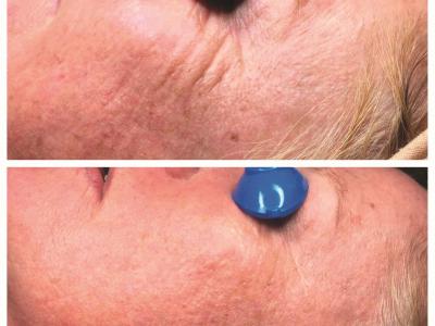 HydroPeptide Collagen Reactivate Treatment Series