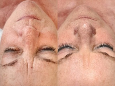 Microneedling