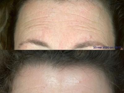 Microneedling