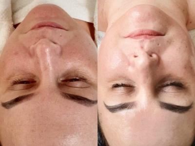 Microneedling