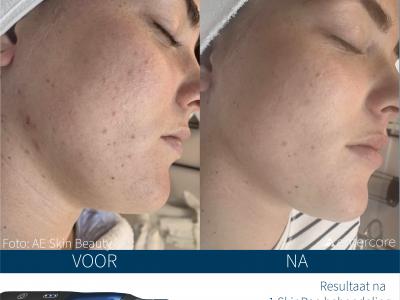 SkinPen Microneedling