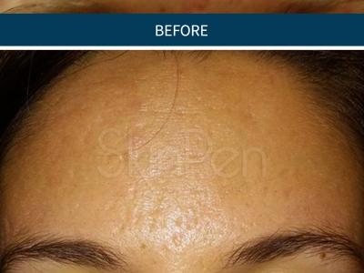 SkinPen Microneedling