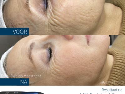 SkinPen Microneedling