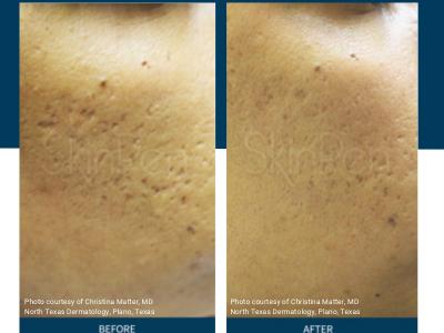 SkinPen Microneedling