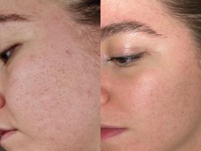 SkinPen Microneedling