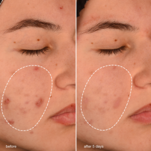 Breakout Biotic Moisturizer
