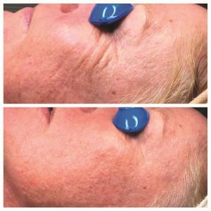 Collagen ReActivate Treatment Series