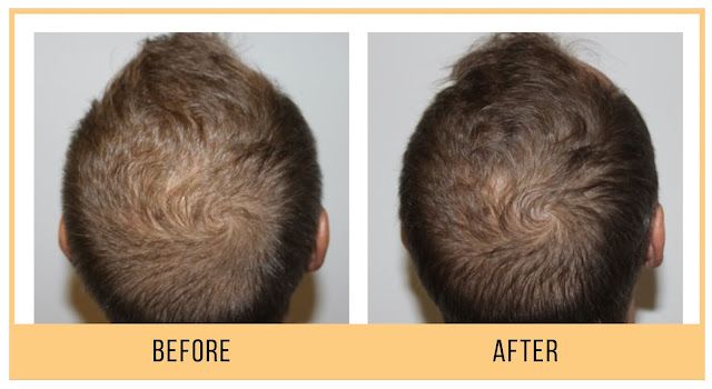 Hydrafacial keravive foto voor en na