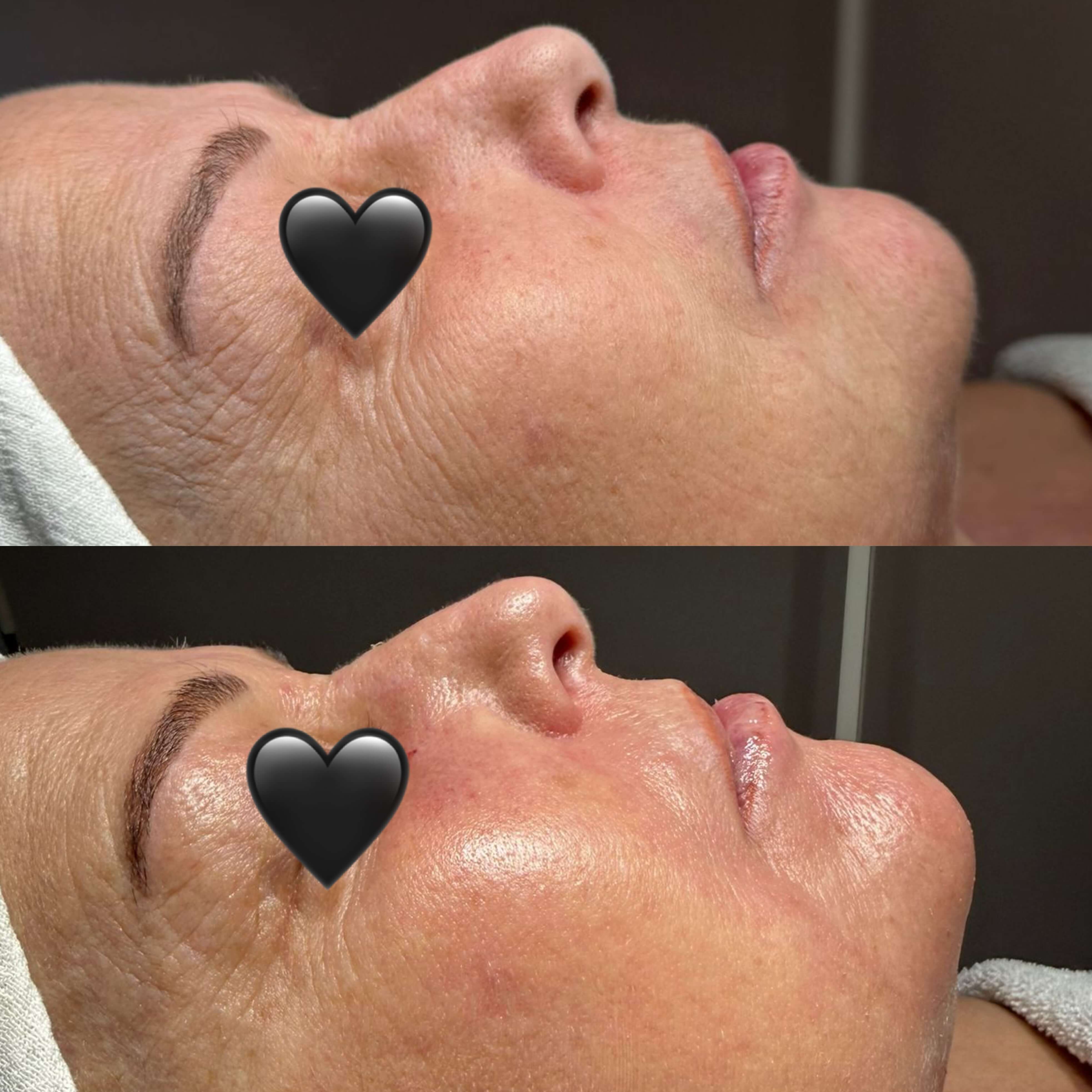 anti aging behandeling voor en na