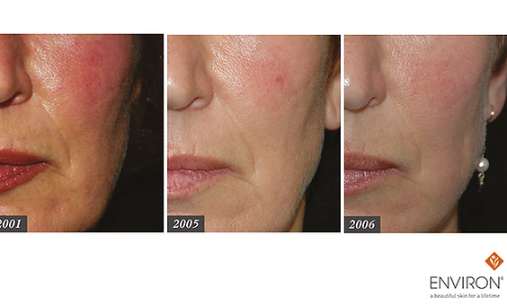 resultaat retinol vitamina a voor en na