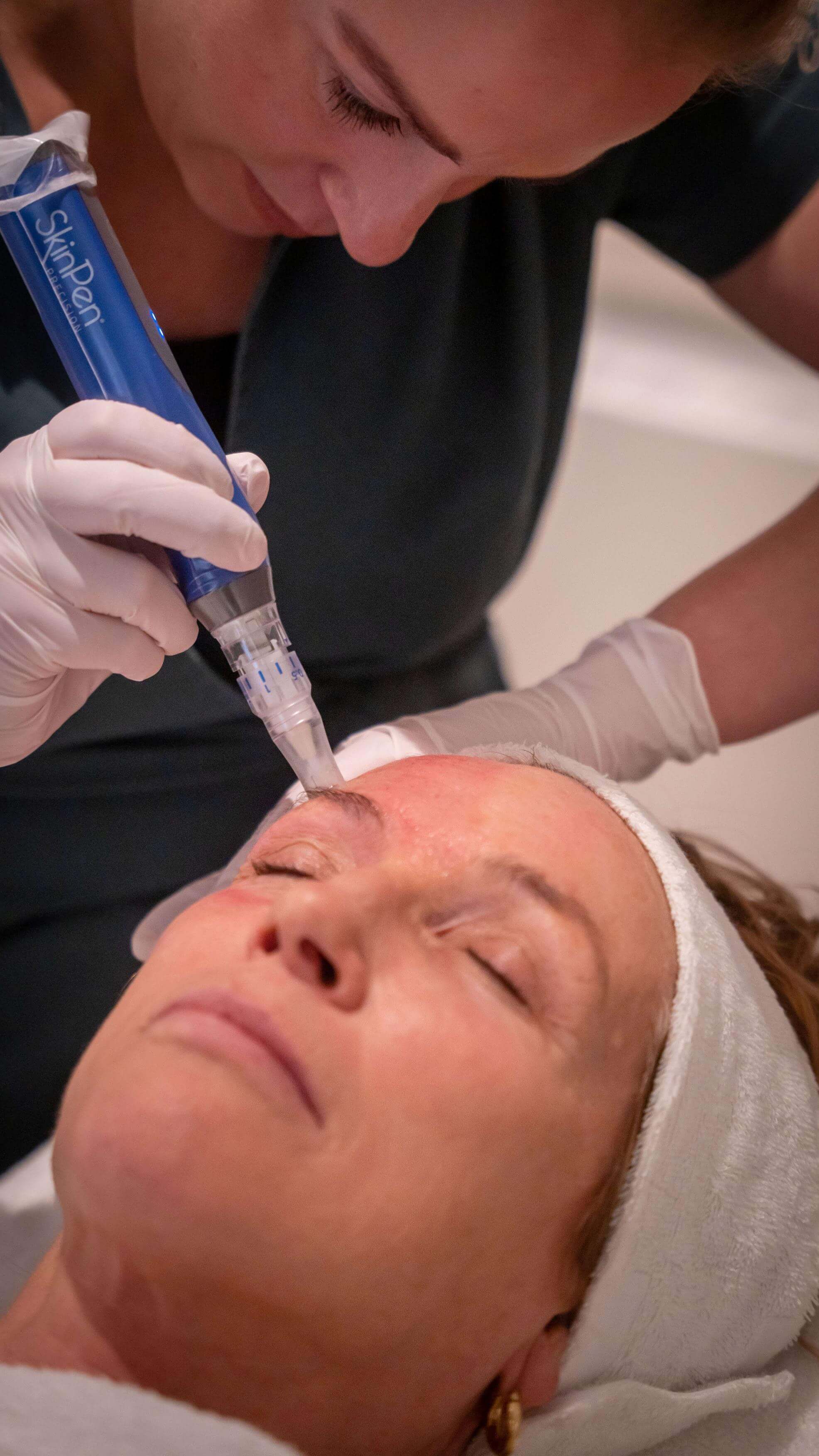 skinpen exosomen